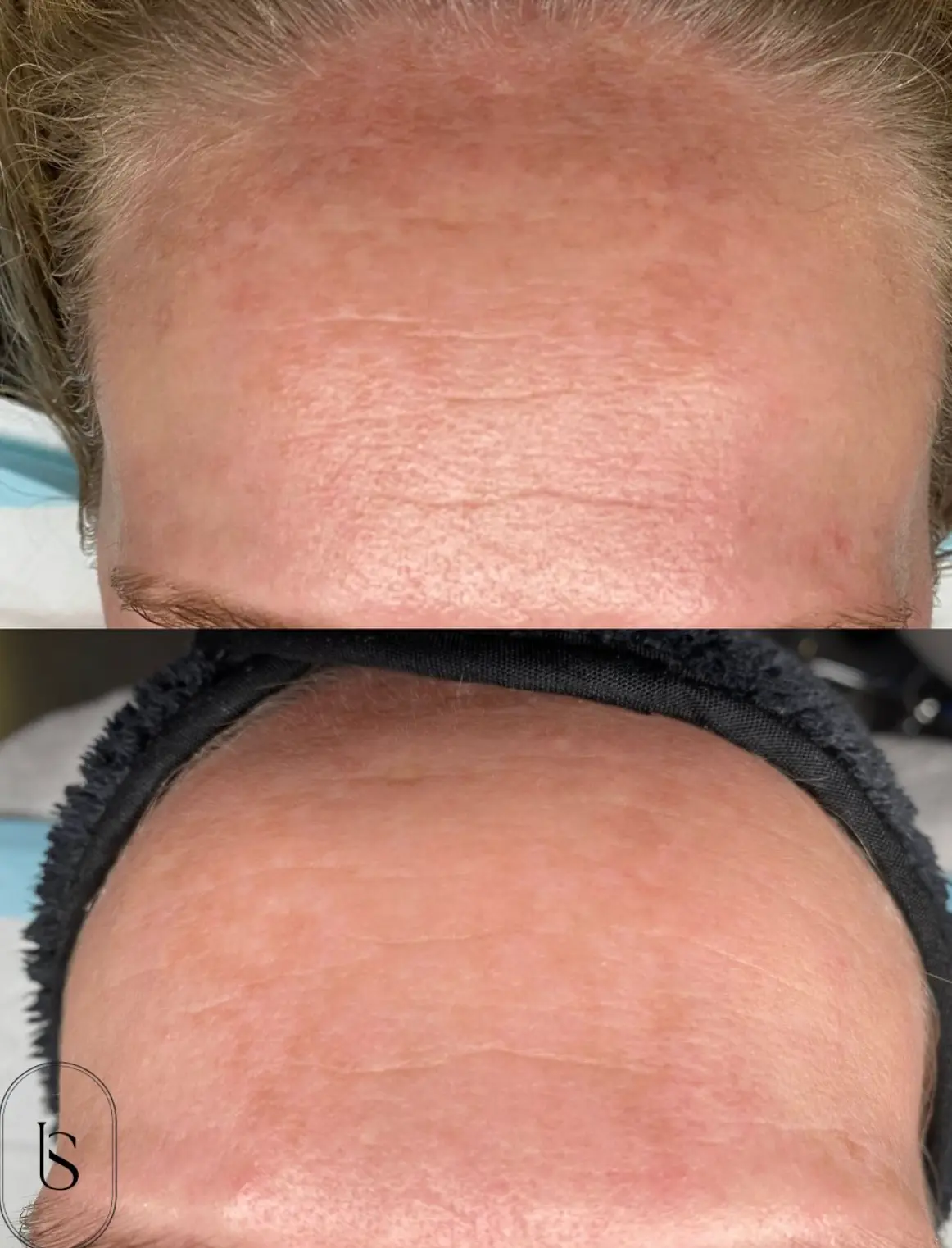 Client skin before and after treatment at Instincts Skin Clinic, result 1